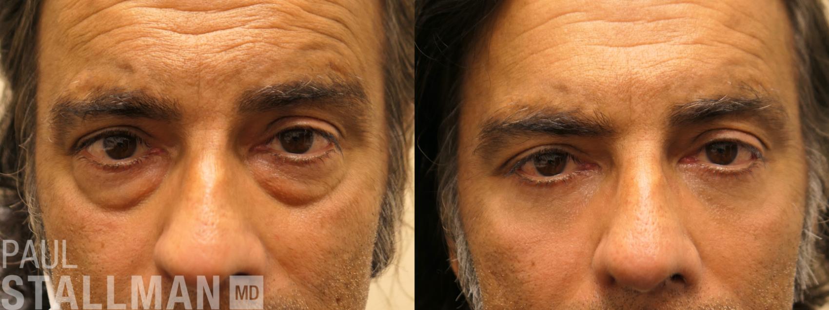 Before & After Blepharoplasty for Men Case 156 Front View in Fresno, Santa Maria, San Luis Obispo, CA