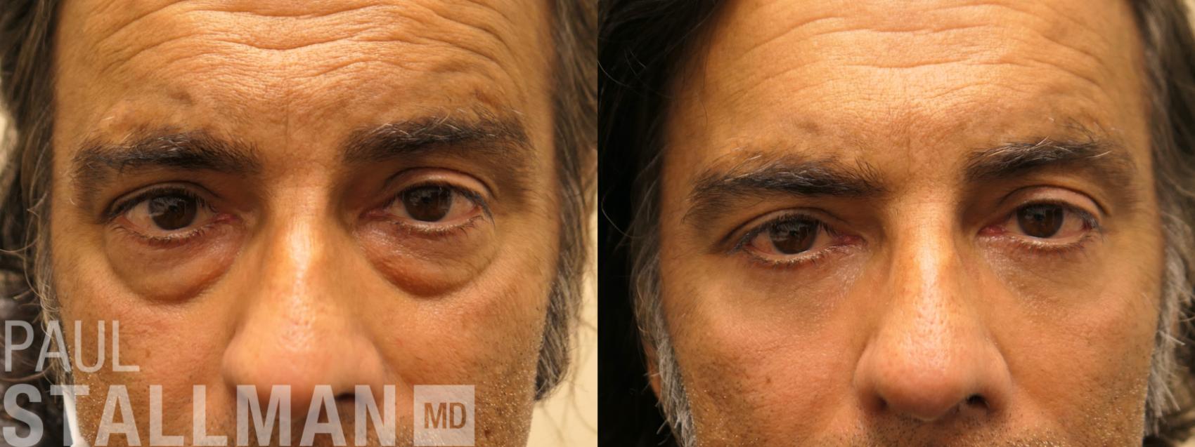 Before & After Blepharoplasty for Men Case 156 Front View in Fresno, Santa Maria, San Luis Obispo, CA