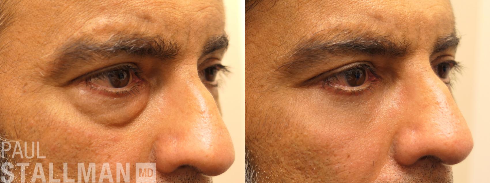 Before & After Blepharoplasty for Men Case 156 Right Oblique View in Fresno, Santa Maria, San Luis Obispo, CA