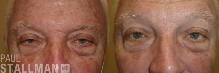 Before & After Blepharoplasty for Men Case 178 Front View in Fresno, Santa Maria, San Luis Obispo, CA