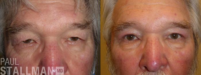 Before & After Blepharoplasty for Men Case 180 Front View in Fresno, Santa Maria, San Luis Obispo, CA