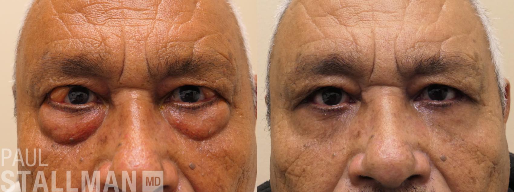 Before & After Blepharoplasty for Men Case 181 Front View in Fresno, Santa Maria, San Luis Obispo, CA