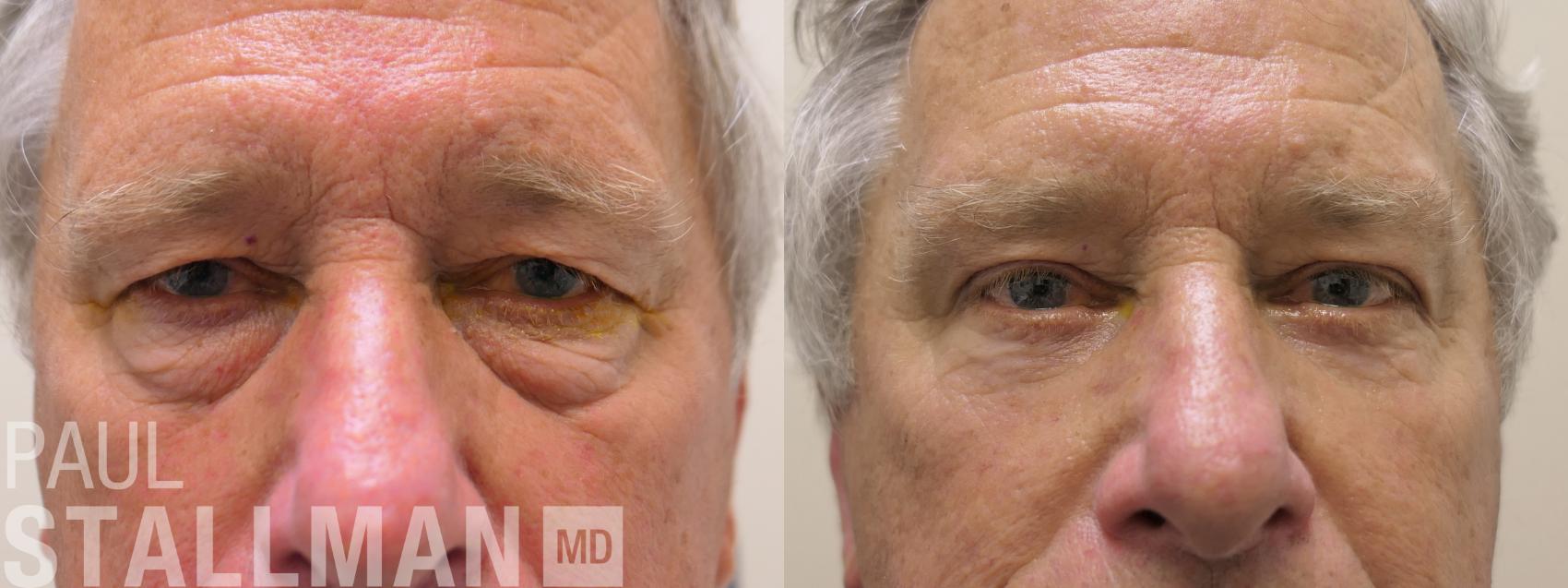 Before & After Blepharoplasty for Men Case 212 Front View in Fresno, Santa Maria, San Luis Obispo, CA