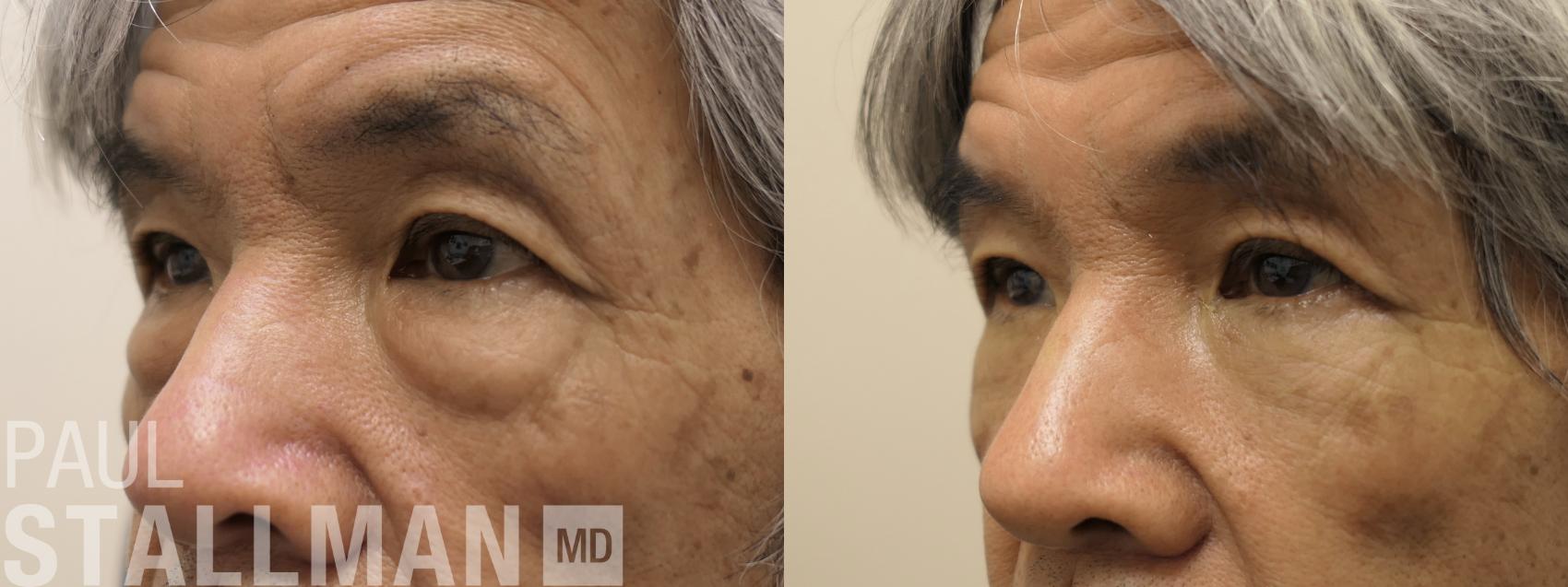 Before & After Blepharoplasty for Men Case 213 Left Oblique View in Fresno, Santa Maria, San Luis Obispo, CA