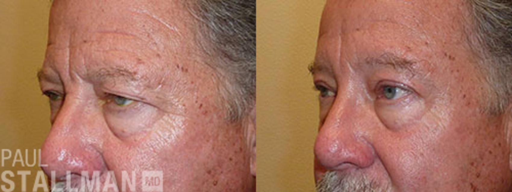 Before & After Blepharoplasty for Men Case 40 View #1 View in Fresno, Santa Maria, San Luis Obispo, CA