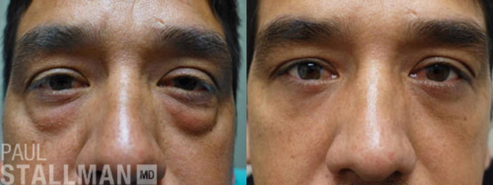 Before & After Blepharoplasty for Men Case 41 View #1 View in Fresno, Santa Maria, San Luis Obispo, CA
