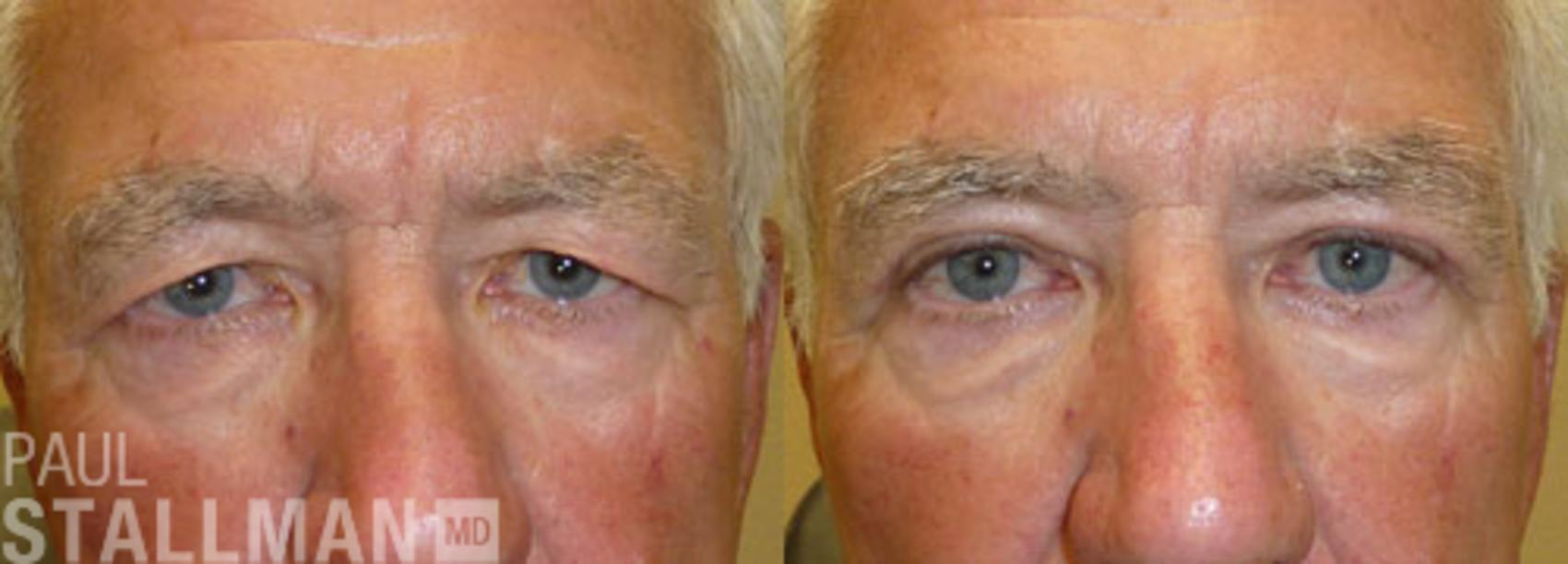Before & After Blepharoplasty for Men Case 42 View #1 View in Fresno, Santa Maria, San Luis Obispo, CA