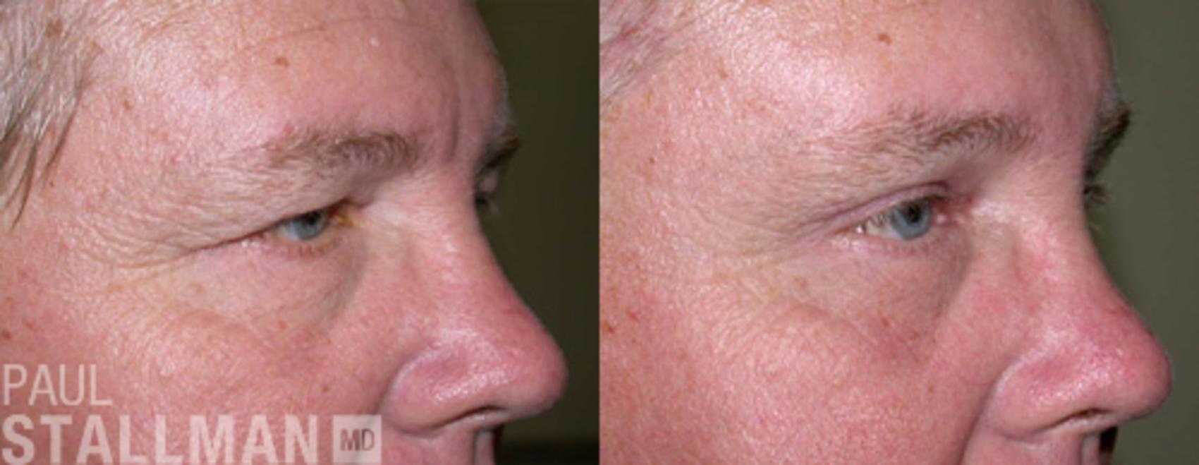 Before & After Blepharoplasty for Men Case 43 View #1 View in Fresno, Santa Maria, San Luis Obispo, CA