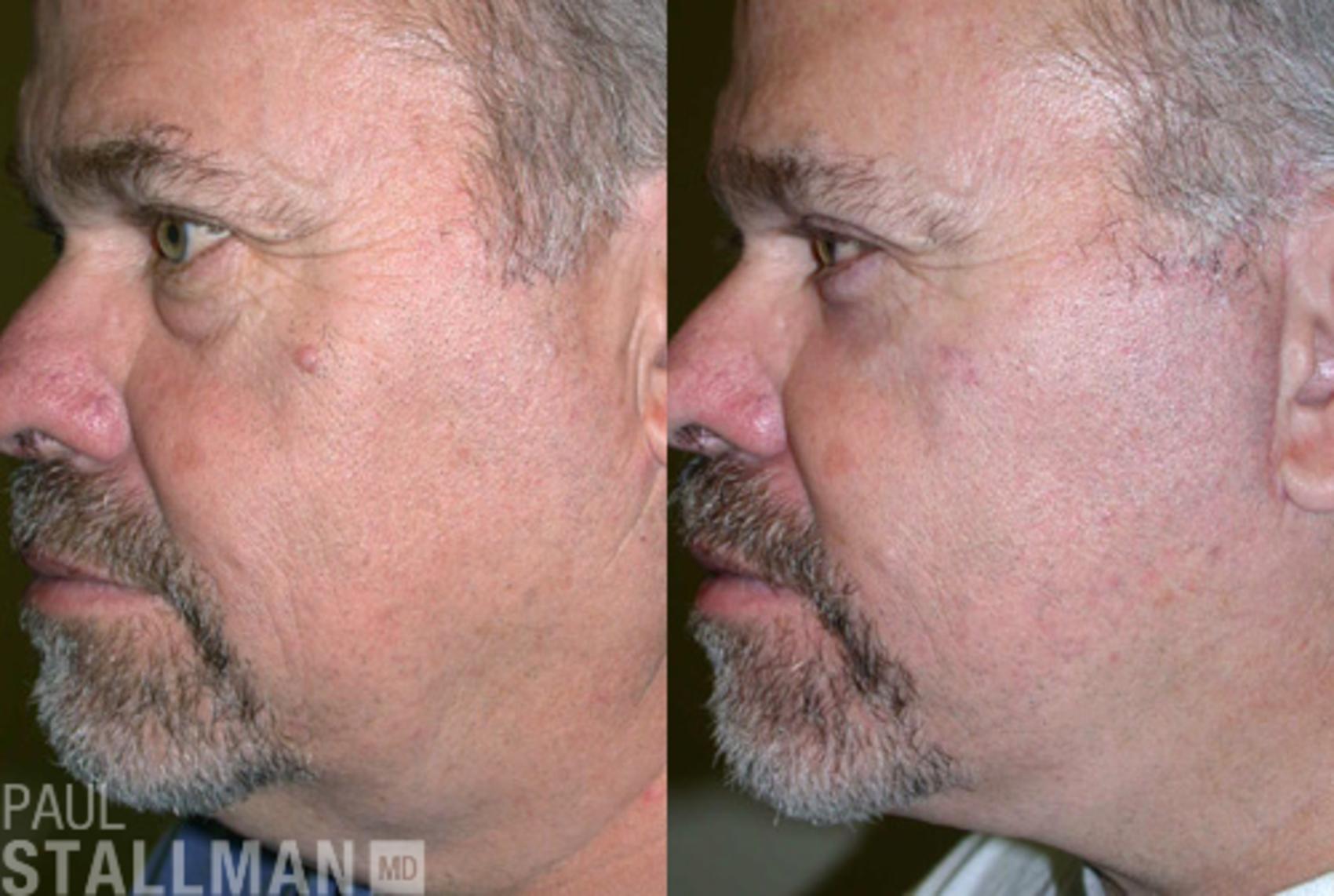 Before & After Blepharoplasty for Men Case 44 View #1 View in Fresno, Santa Maria, San Luis Obispo, CA