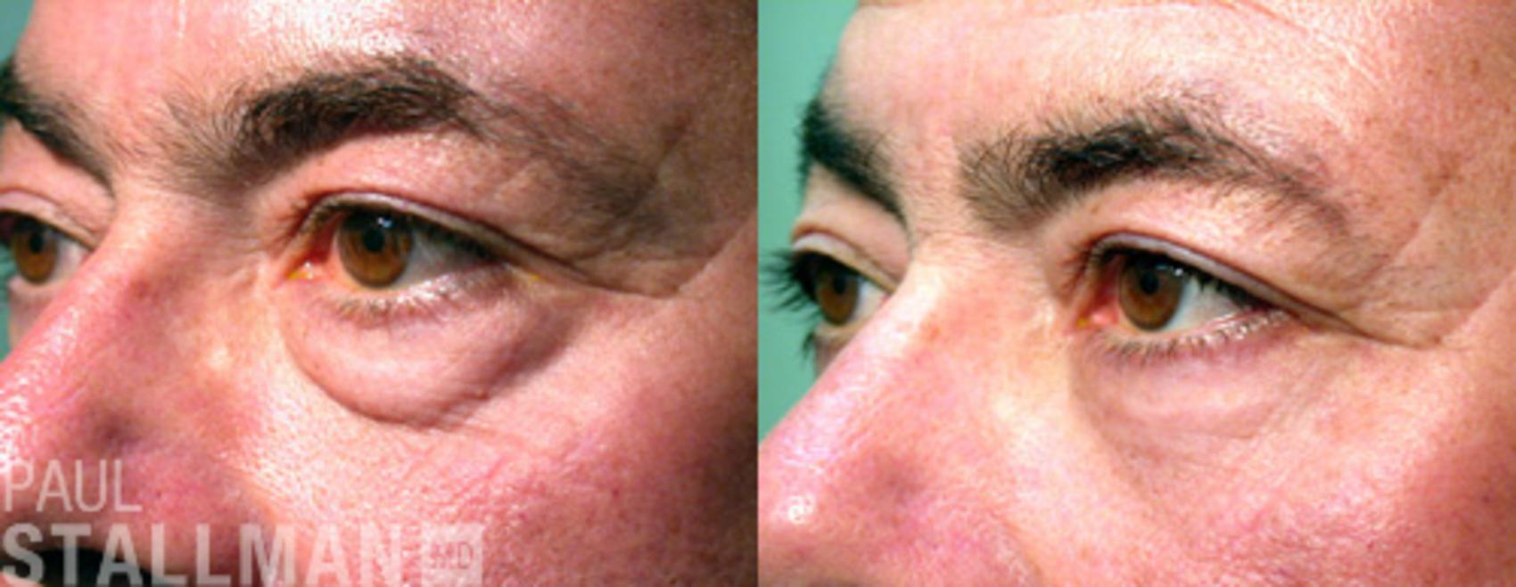Before & After Blepharoplasty for Men Case 45 View #1 View in Fresno, Santa Maria, San Luis Obispo, CA