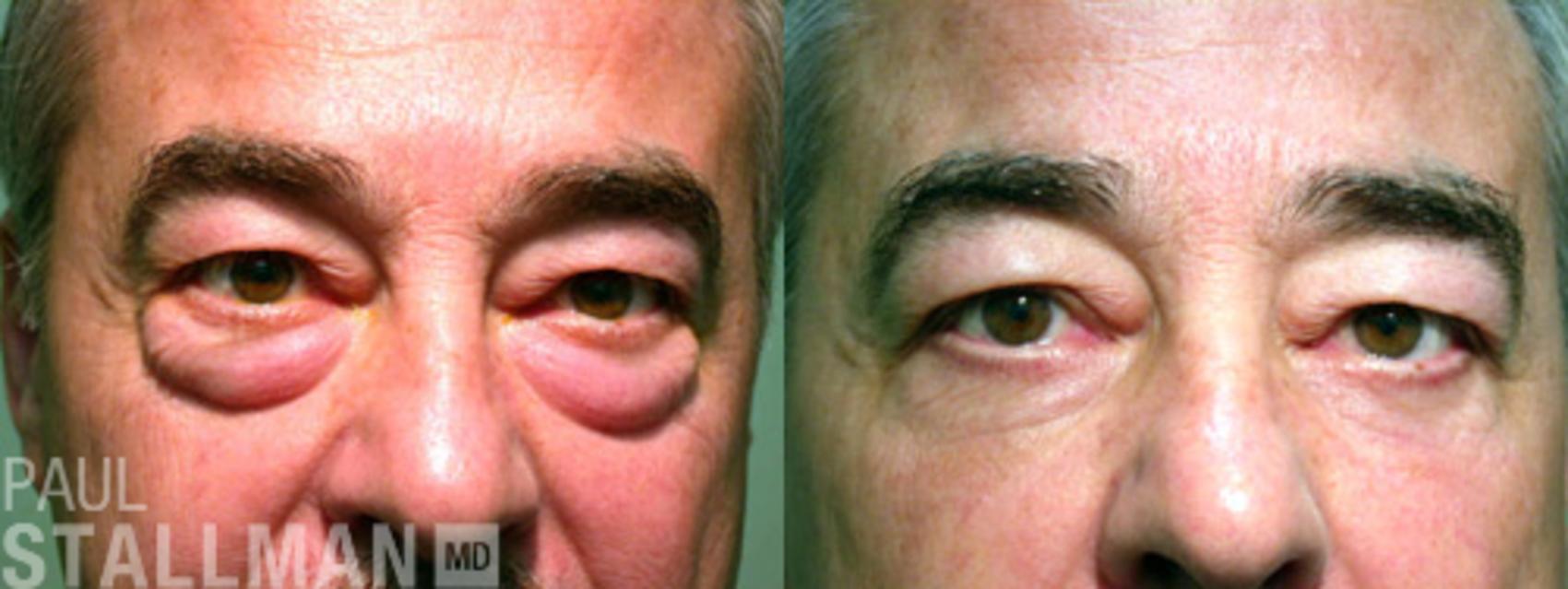 Before & After Blepharoplasty for Men Case 46 View #1 View in Fresno, Santa Maria, San Luis Obispo, CA