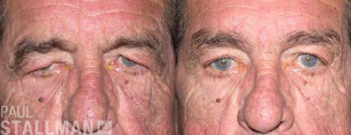 Before & After Blepharoplasty for Men Case 47 View #1 View in Fresno, Santa Maria, San Luis Obispo, CA