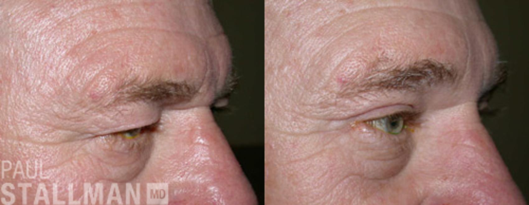 Before & After Blepharoplasty for Men Case 48 View #1 View in Fresno, Santa Maria, San Luis Obispo, CA