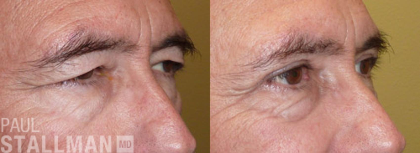 Before & After Blepharoplasty for Men Case 50 View #1 View in Fresno, Santa Maria, San Luis Obispo, CA