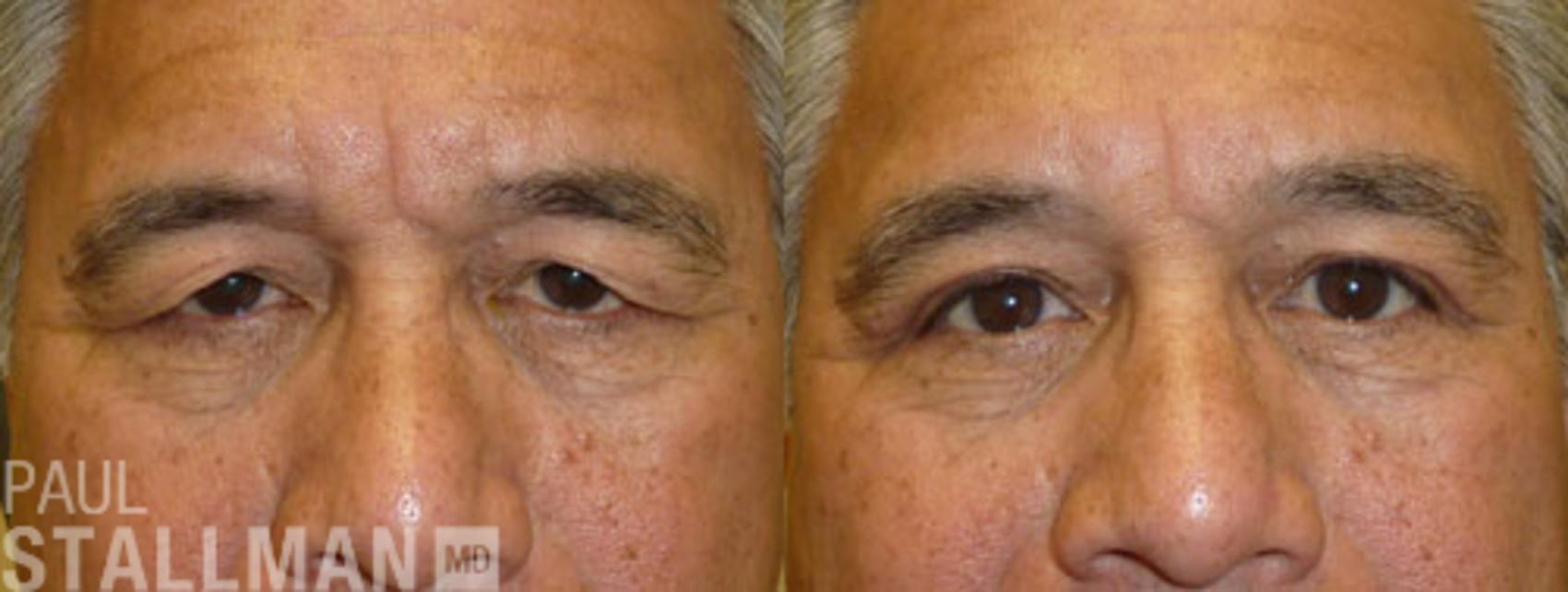 Before & After Blepharoplasty for Men Case 51 View #1 View in Fresno, Santa Maria, San Luis Obispo, CA