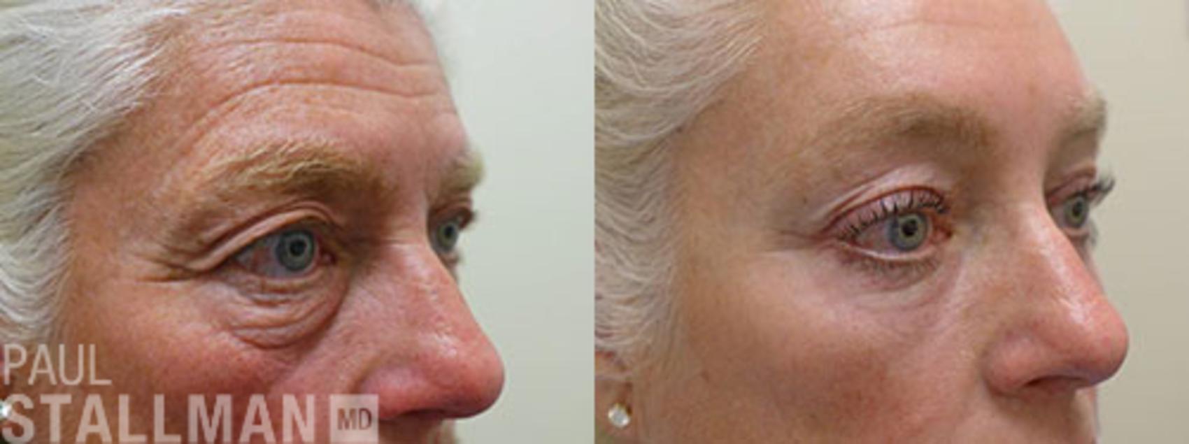Before & After Blepharoplasty for Women Case 1 View #1 View in Fresno, Santa Maria, San Luis Obispo, CA