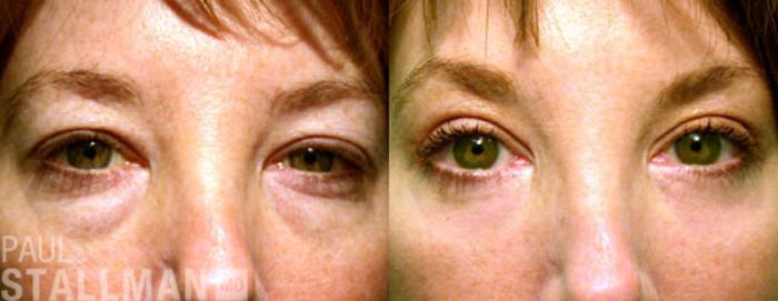 Before & After Blepharoplasty for Women Case 10 View #1 View in Fresno, Santa Maria, San Luis Obispo, CA