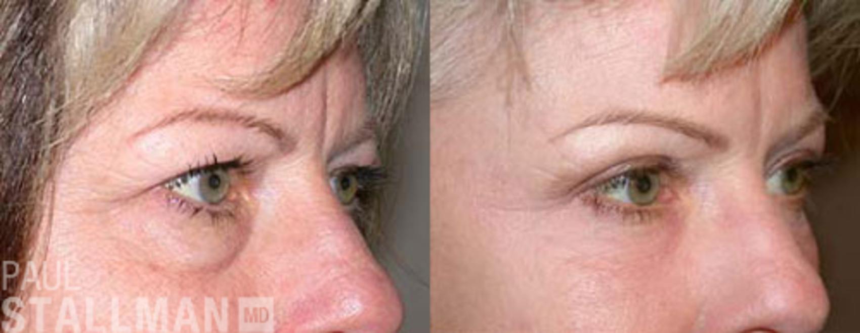 Before & After Blepharoplasty for Women Case 11 View #1 View in Fresno, Santa Maria, San Luis Obispo, CA