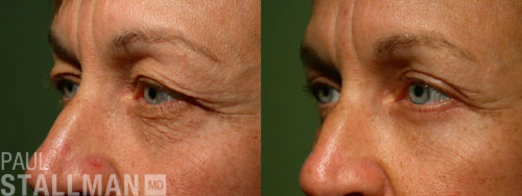 Before & After Blepharoplasty for Women Case 12 View #1 View in Fresno, Santa Maria, San Luis Obispo, CA