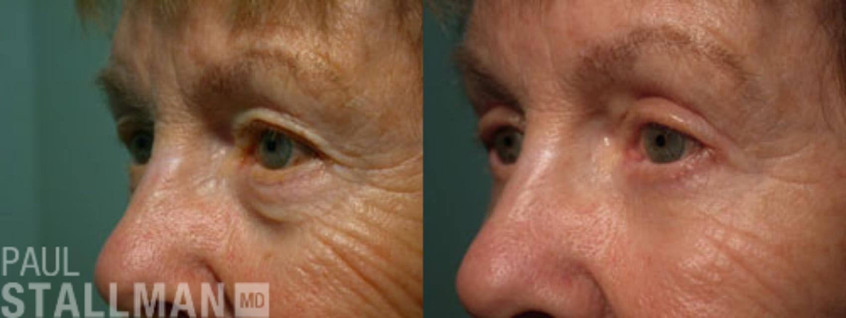 Before & After Blepharoplasty for Women Case 13 View #1 View in Fresno, Santa Maria, San Luis Obispo, CA