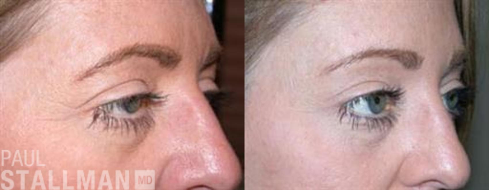 Before & After Blepharoplasty for Women Case 14 View #1 View in Fresno, Santa Maria, San Luis Obispo, CA