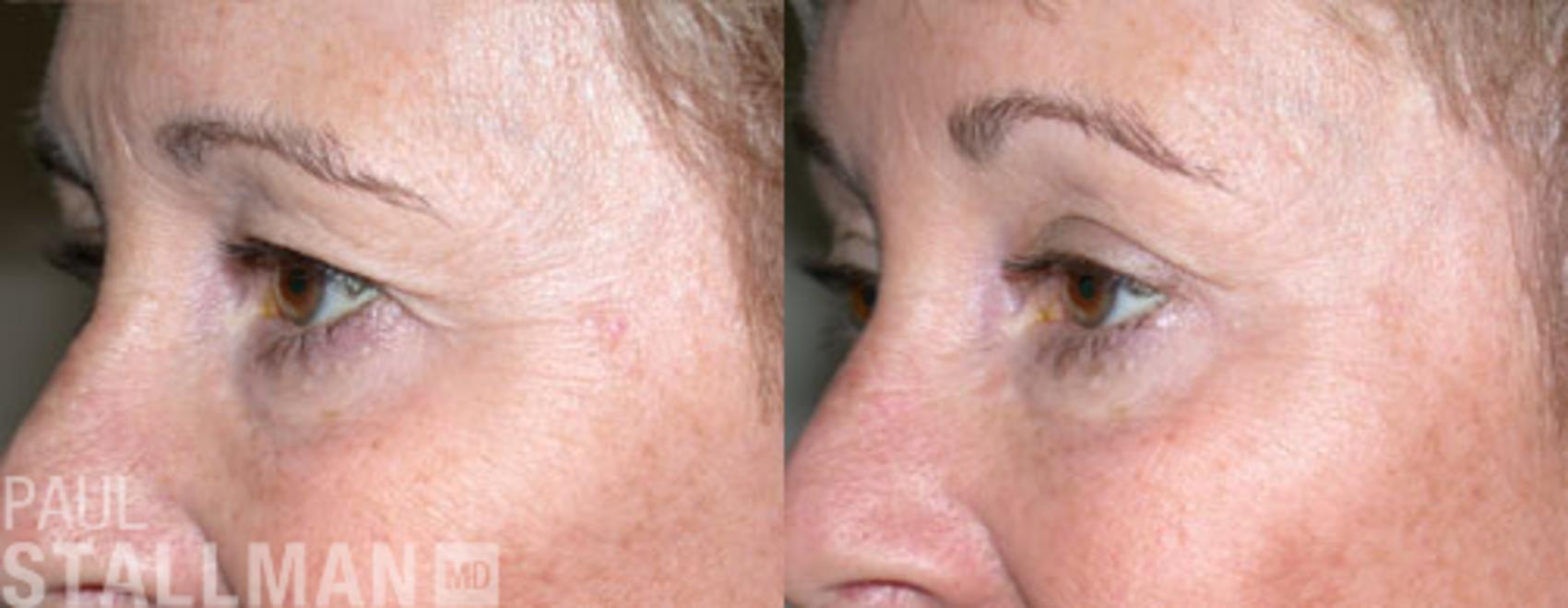 Before & After Blepharoplasty for Women Case 15 View #1 View in Fresno, Santa Maria, San Luis Obispo, CA