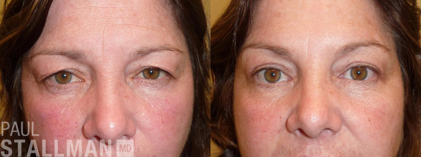 Before & After Blepharoplasty for Women Case 157 Front View in Fresno, Santa Maria, San Luis Obispo, CA