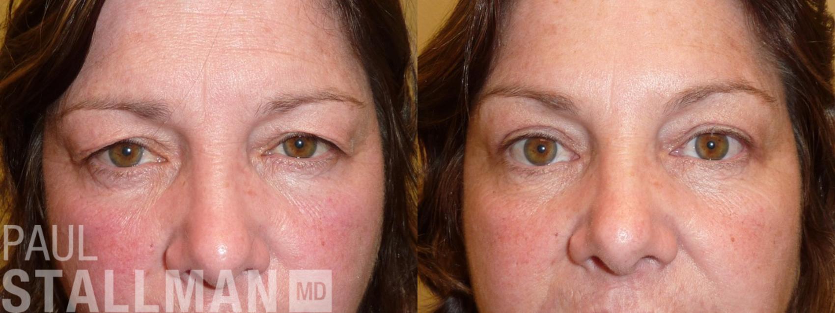 Before & After Blepharoplasty for Women Case 157 Front View in Fresno, Santa Maria, San Luis Obispo, CA