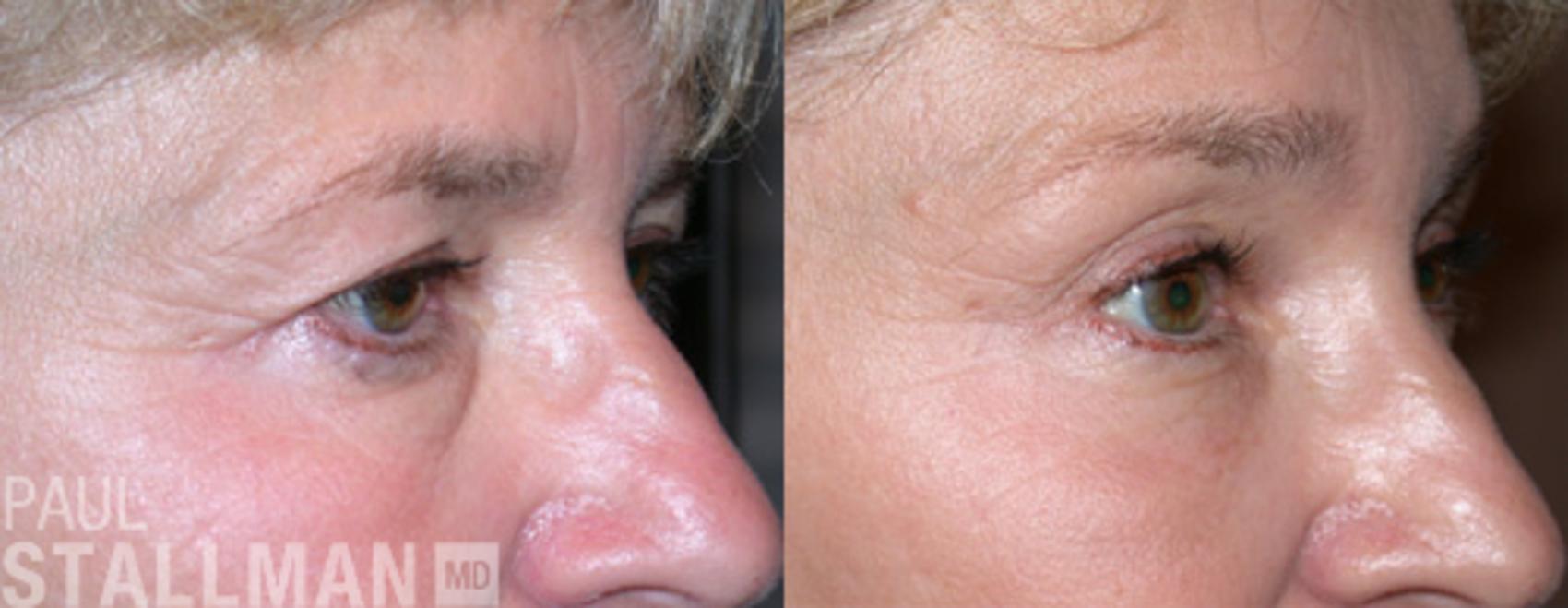 Before & After Blepharoplasty for Women Case 16 View #1 View in Fresno, Santa Maria, San Luis Obispo, CA