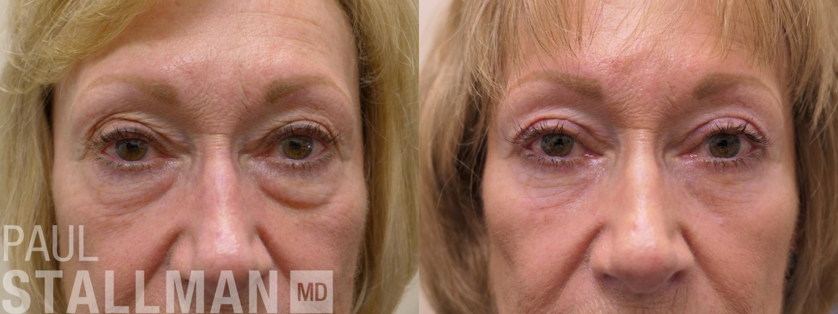 Before & After Blepharoplasty for Women Case 161 Front View in Fresno, Santa Maria, San Luis Obispo, CA