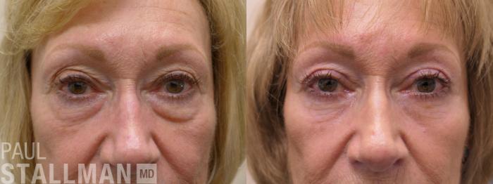 Before & After Blepharoplasty for Women Case 161 Front View in Fresno, Santa Maria, San Luis Obispo, CA