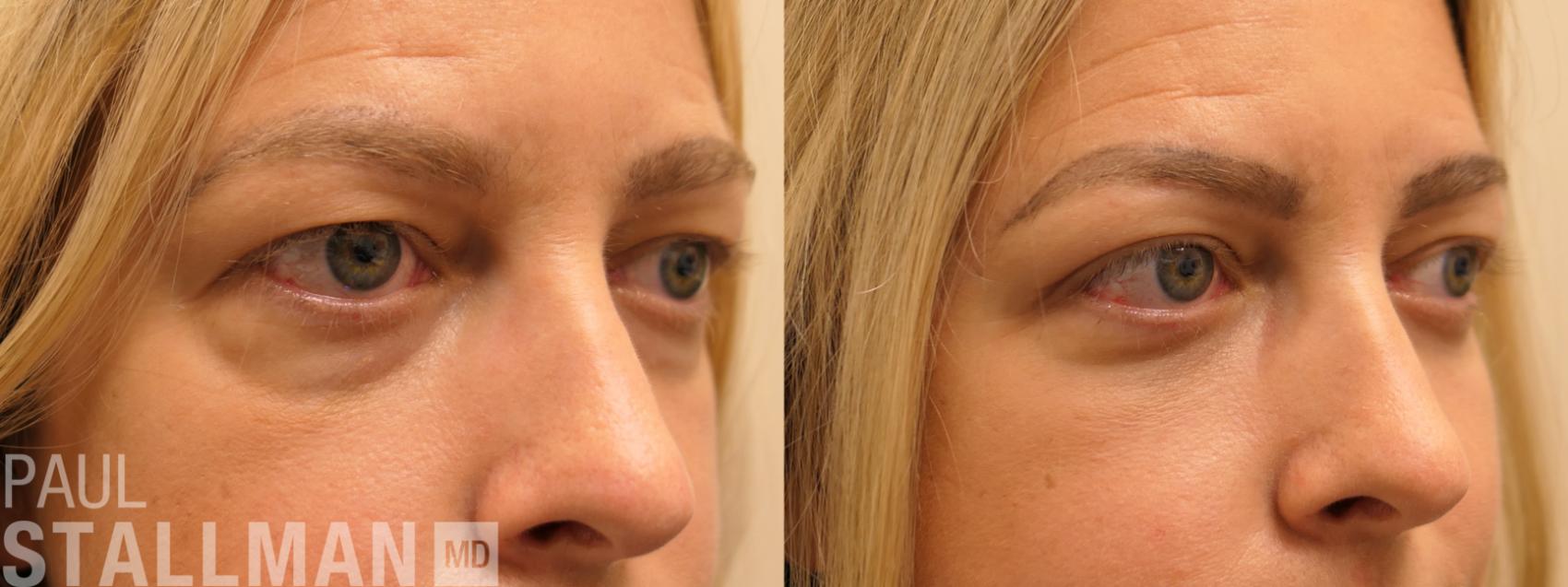 Before & After Blepharoplasty for Women Case 164 Right Oblique View in Fresno, Santa Maria, San Luis Obispo, CA