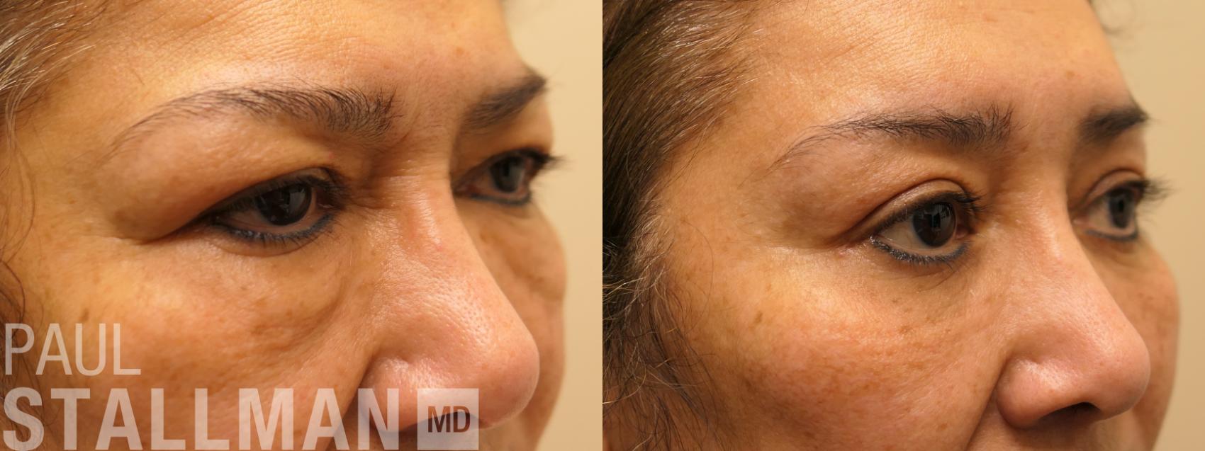 Before & After Blepharoplasty for Women Case 165 Right Oblique View in Fresno, Santa Maria, San Luis Obispo, CA