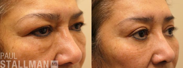 Before & After Blepharoplasty for Women Case 165 Right Oblique View in Fresno, Santa Maria, San Luis Obispo, CA