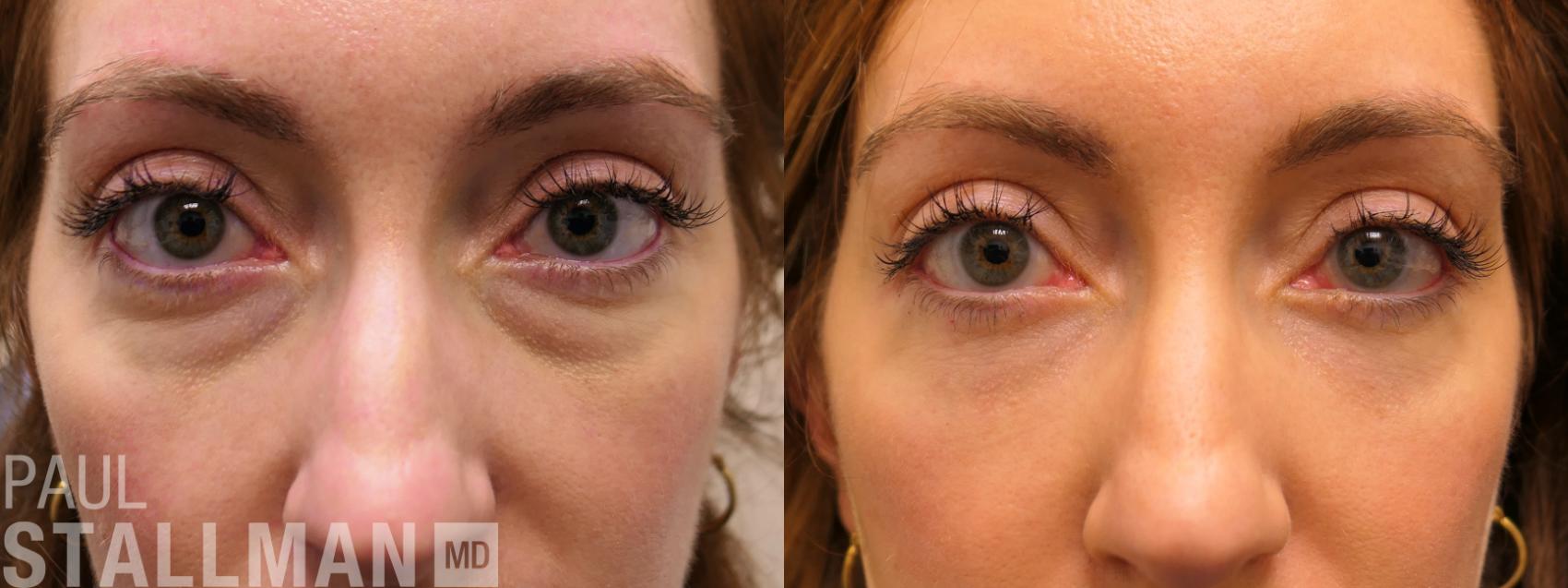 Before & After Blepharoplasty for Women Case 166 Front View in Fresno, Santa Maria, San Luis Obispo, CA