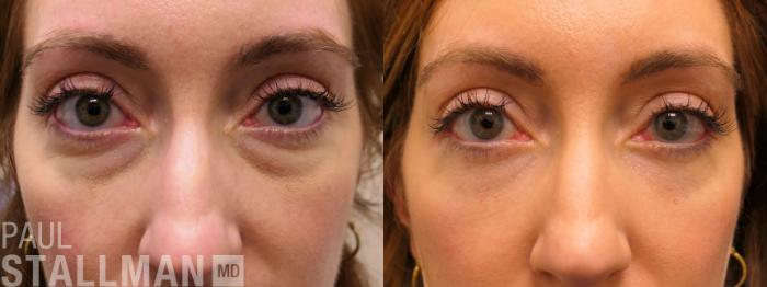 Before & After Blepharoplasty for Women Case 166 Front View in Fresno, Santa Maria, San Luis Obispo, CA