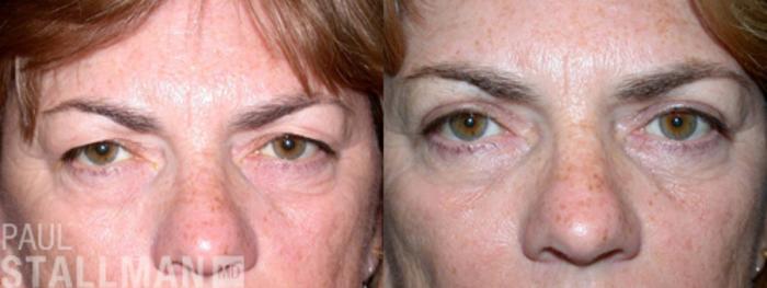 Before & After Blepharoplasty for Women Case 17 View #1 View in Fresno, Santa Maria, San Luis Obispo, CA