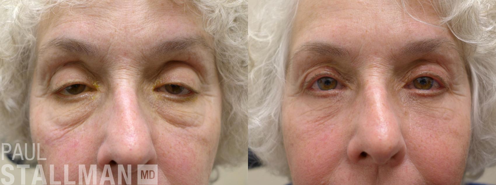 Before & After Blepharoplasty for Women Case 171 Front View in Fresno, Santa Maria, San Luis Obispo, CA