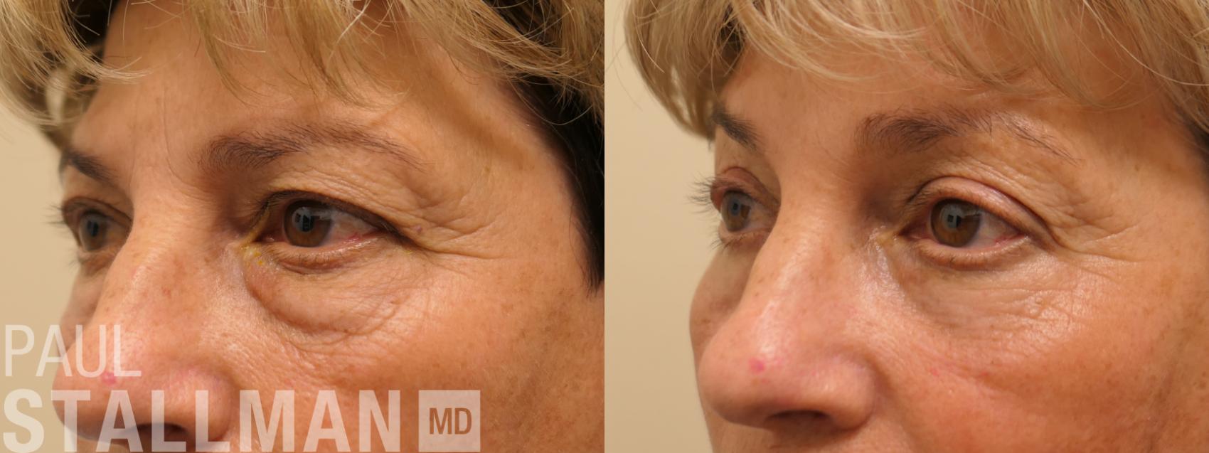 Before & After Blepharoplasty for Women Case 174 Left Oblique View in Fresno, Santa Maria, San Luis Obispo, CA