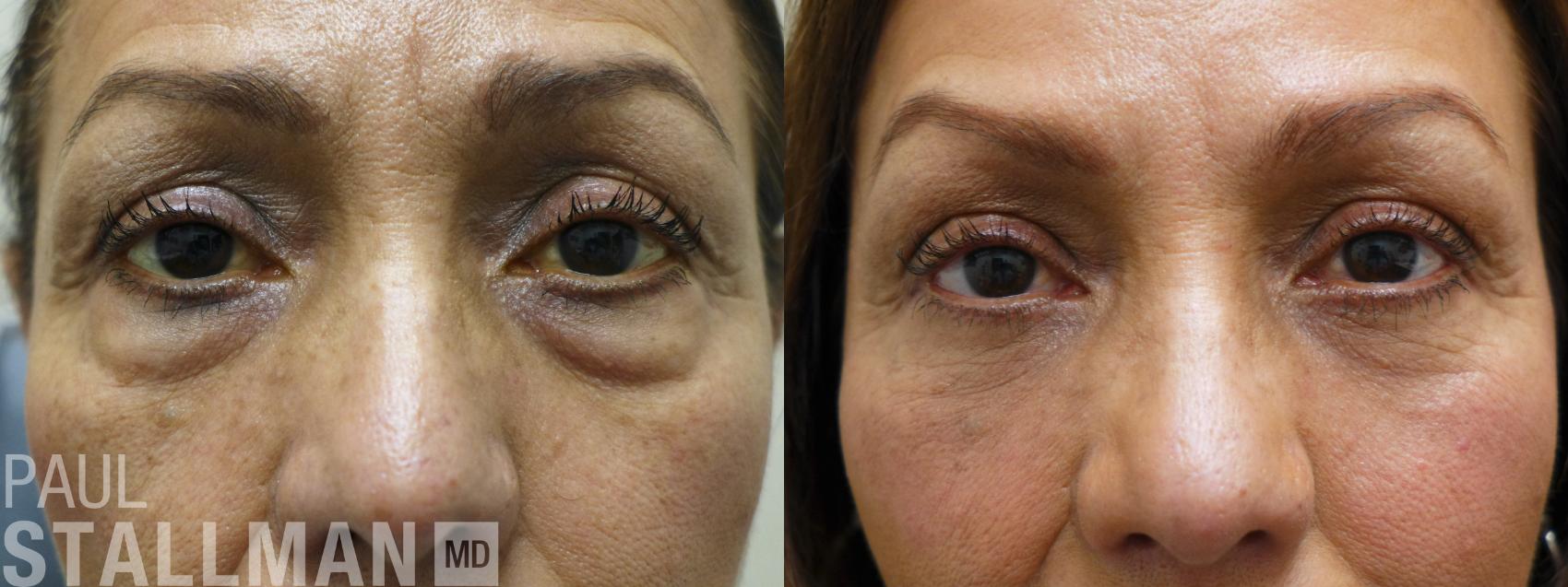 Before & After Blepharoplasty for Women Case 176 Front View in Fresno, Santa Maria, San Luis Obispo, CA