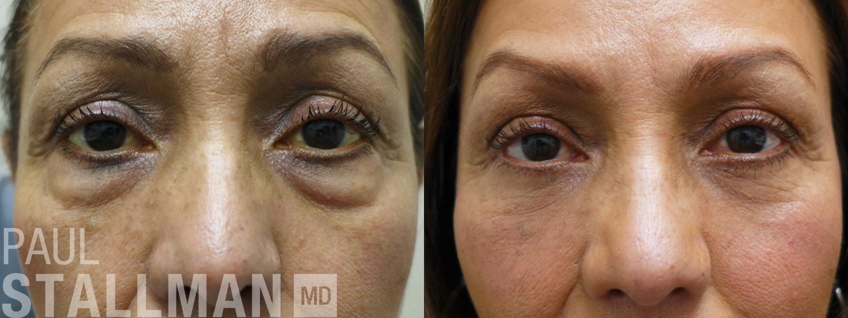 Before & After Blepharoplasty for Women Case 176 Front View in Fresno, Santa Maria, San Luis Obispo, CA