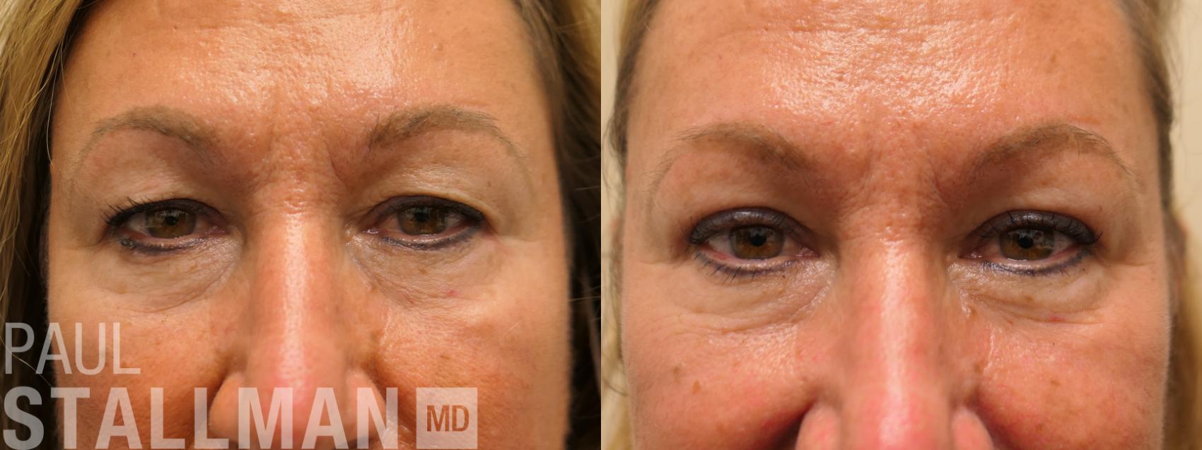 Before & After Blepharoplasty for Women Case 177 Front View in Fresno, Santa Maria, San Luis Obispo, CA