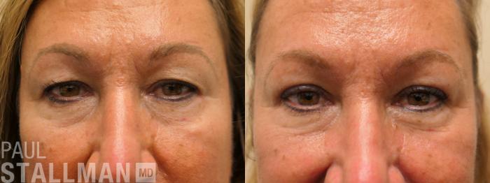 Before & After Blepharoplasty for Women Case 177 Front View in Fresno, Santa Maria, San Luis Obispo, CA