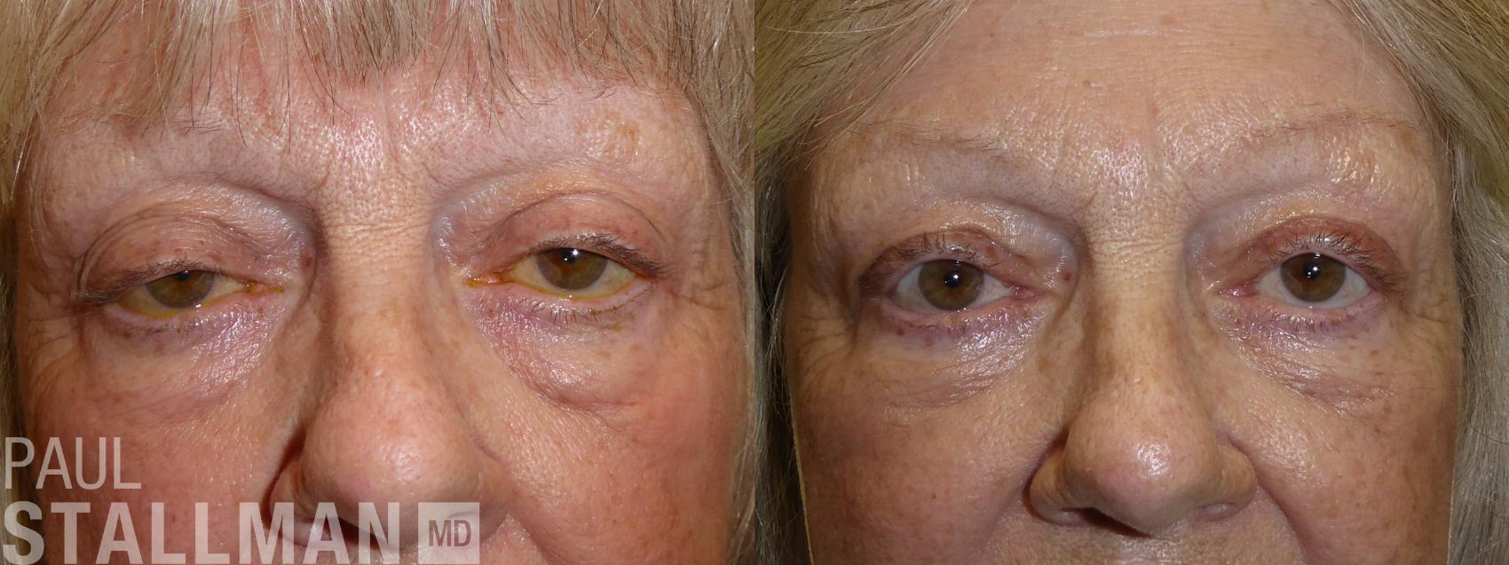 Before & After Blepharoplasty for Women Case 179 Front View in Fresno, Santa Maria, San Luis Obispo, CA
