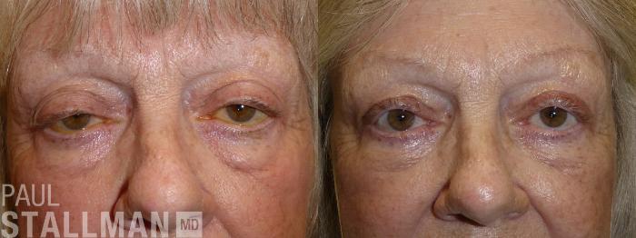 Before & After Blepharoplasty for Women Case 179 Front View in Fresno, Santa Maria, San Luis Obispo, CA