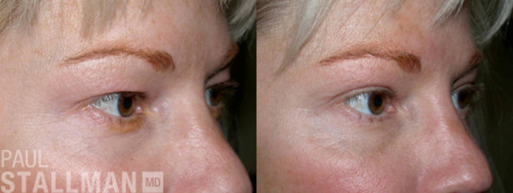 Before & After Blepharoplasty for Women Case 18 View #1 View in Fresno, Santa Maria, San Luis Obispo, CA