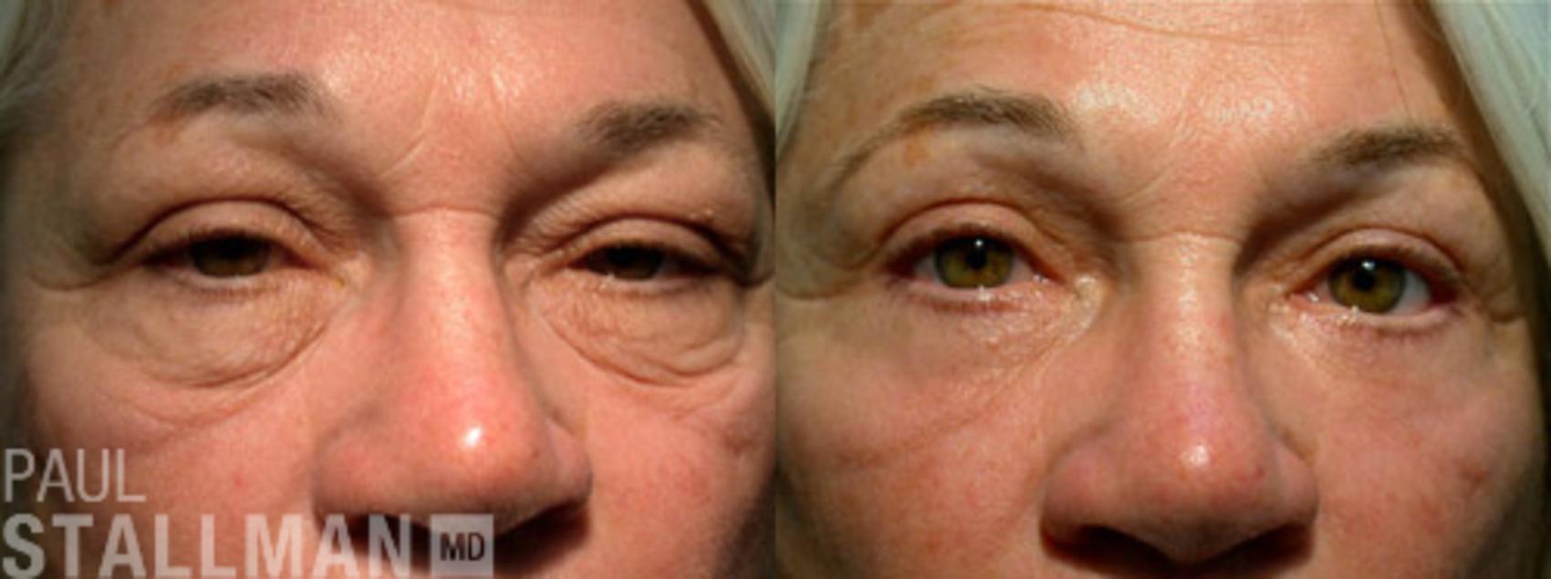 Before & After Blepharoplasty for Women Case 19 View #1 View in Fresno, Santa Maria, San Luis Obispo, CA