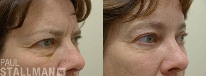 Before & After Blepharoplasty for Women Case 2 View #1 View in Fresno, Santa Maria, San Luis Obispo, CA