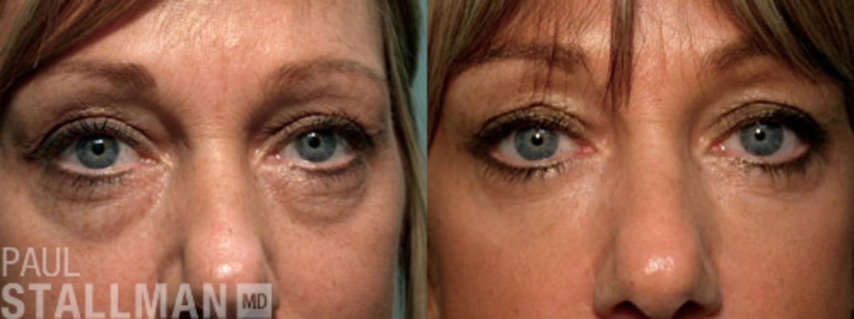 Before & After Blepharoplasty for Women Case 20 View #1 View in Fresno, Santa Maria, San Luis Obispo, CA