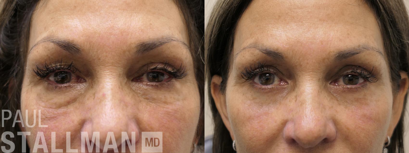 Before & After Laser Resurfacing Case 202 Front View in Fresno, Santa Maria, San Luis Obispo, CA